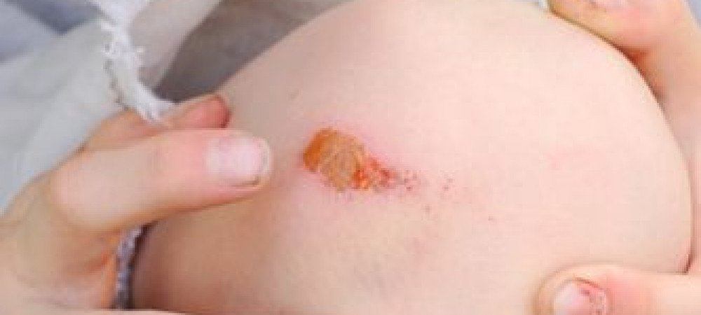 Tetanus: is een inenting nodig voor je op reis vertrekt?